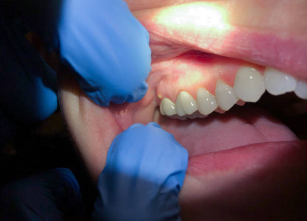 Best Emergency Treatment for Dental Infections or Abscesses in Edgewood, WA